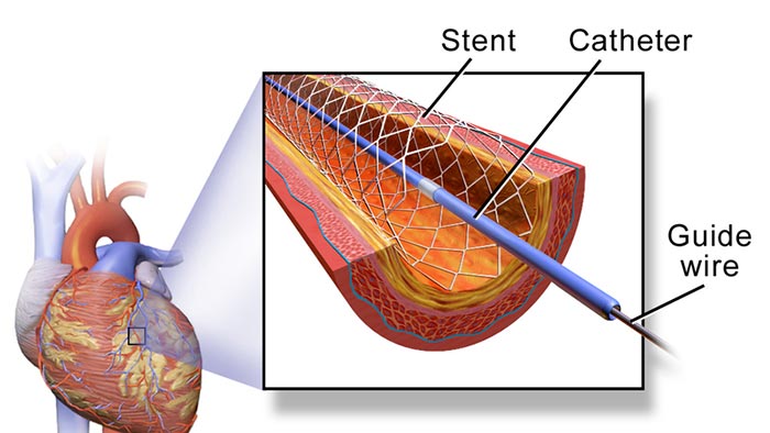 BioDesign Program Sparks A Start up Close To The Heart BioDesign Program Sparks A Start up Close To The Heart